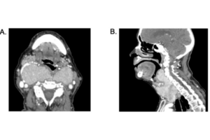 CT scan axial retropharyngeal goitre