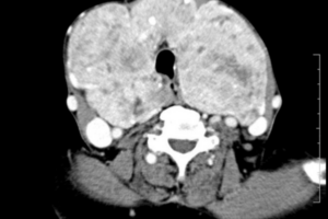 CT scan axial view large goitre