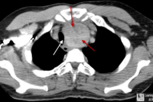 CT scan axial view retrosternal goitre