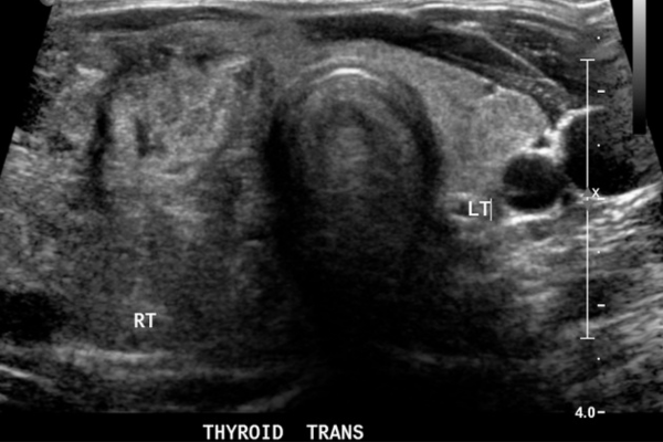 Ultrasound transverse view goitre right lobe