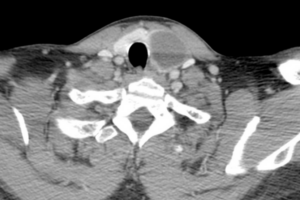 Axial CT scan showing large left thyroid cyst with displacement of the trachea