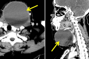 Axial CT scan showing large left thyroid cyst with displacement of the trachea